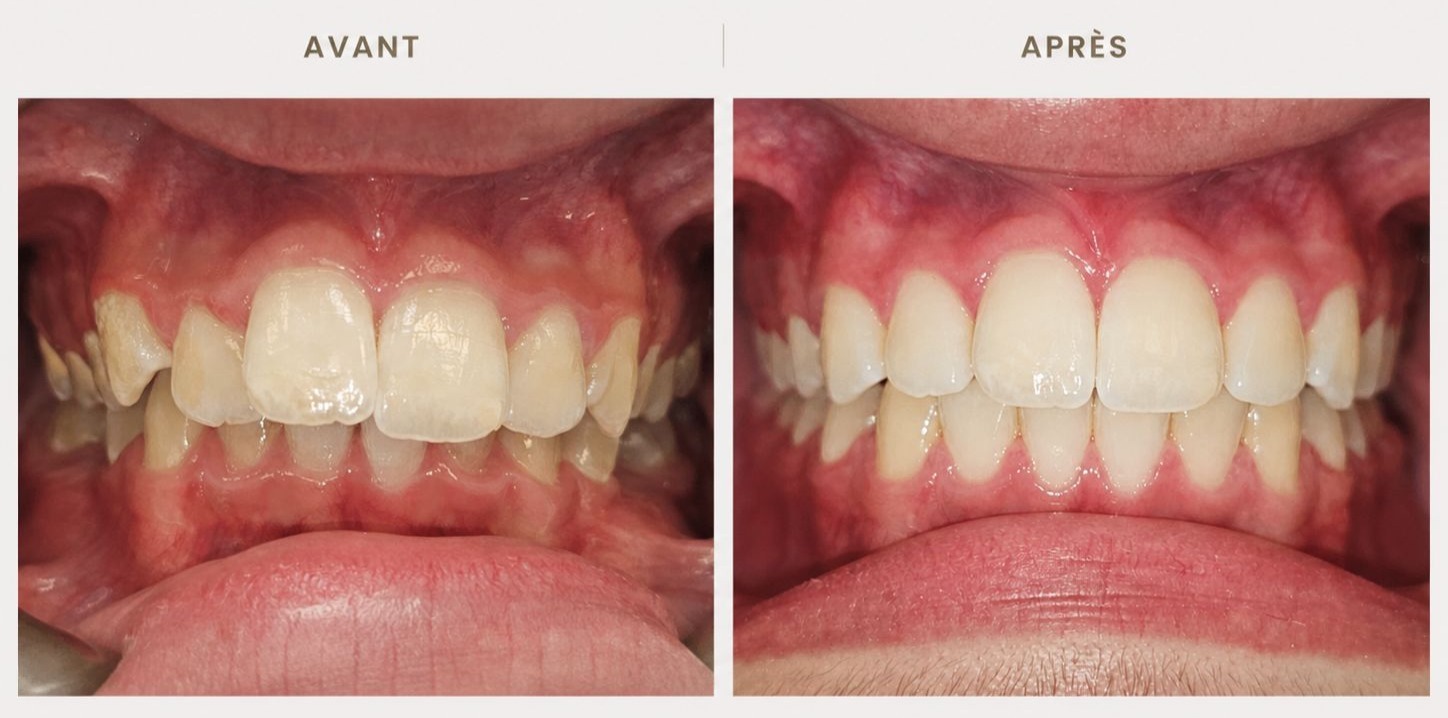 Orthodontie — photographie avant et après, cas clinique 1