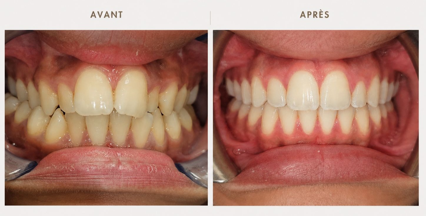 Orthodontie — photographie avant et après, cas clinique 2